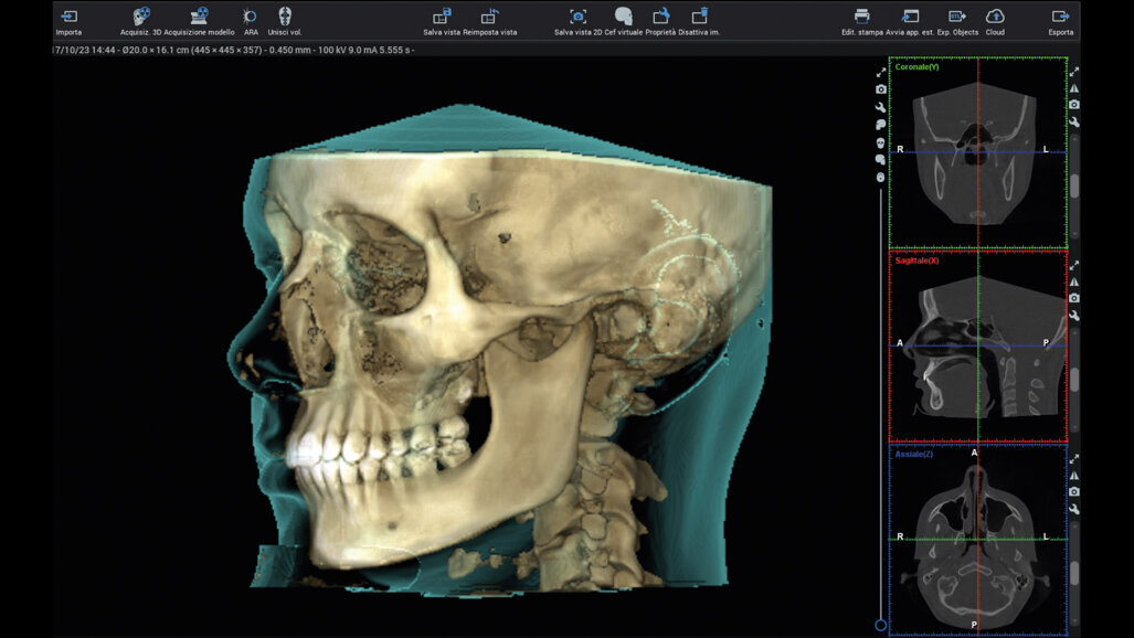 Utilizzo della tomografia computerizzata  a fascio conico, dei file STL  e dell’intelligenza artificiale