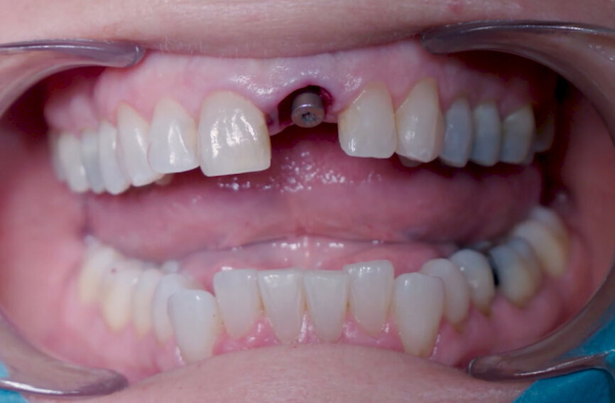 Fig. 13: Healing abutment to protect connection.