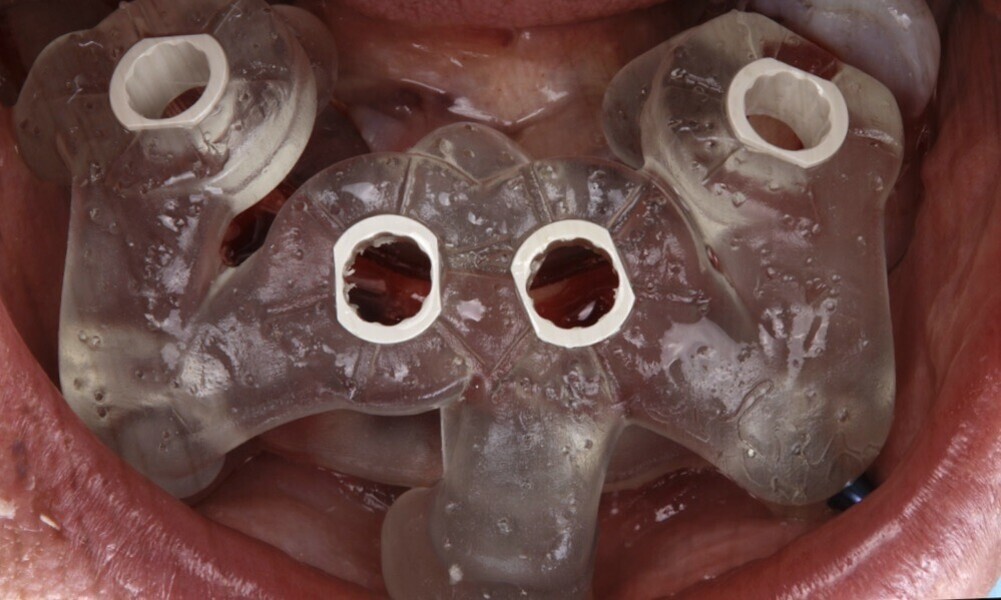 Figs. 40–43: The third surgical guide was placed and the implant bed prepared.