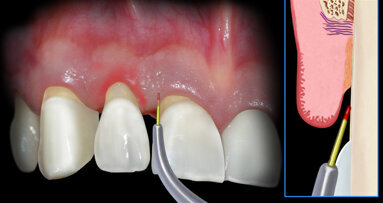Il laser a Diodo: tecniche operative step by step, applicazioni, protocolli e casi clinici con follow-up