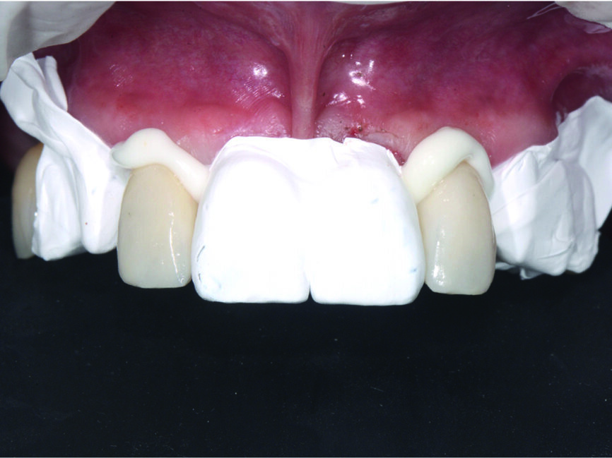 Fig. 12 : Scellement des incisives latérales supérieures avec protection en PTFE.
