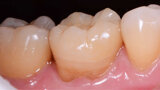 Figs. 12a y 12b. Vista final lateral y oclusal.