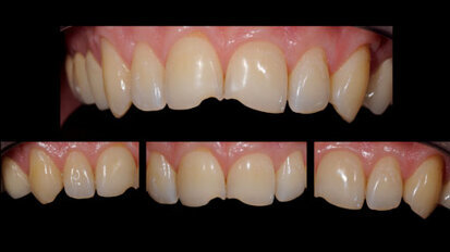 Ästhetisch-funktionelle Veneers bei habituellen Dysfunktionen?