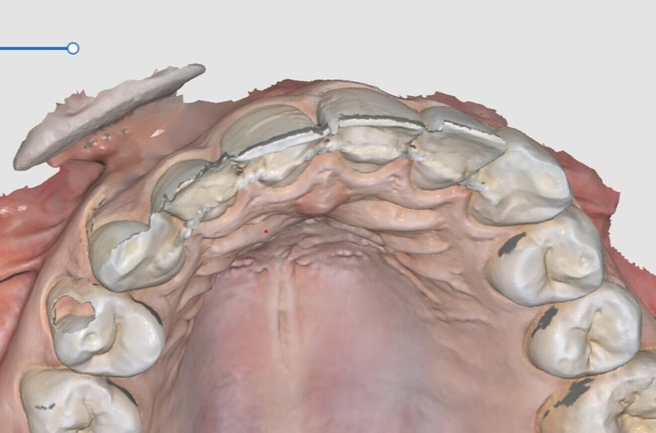 Fig. 6: An example of double images at the incisal edges.