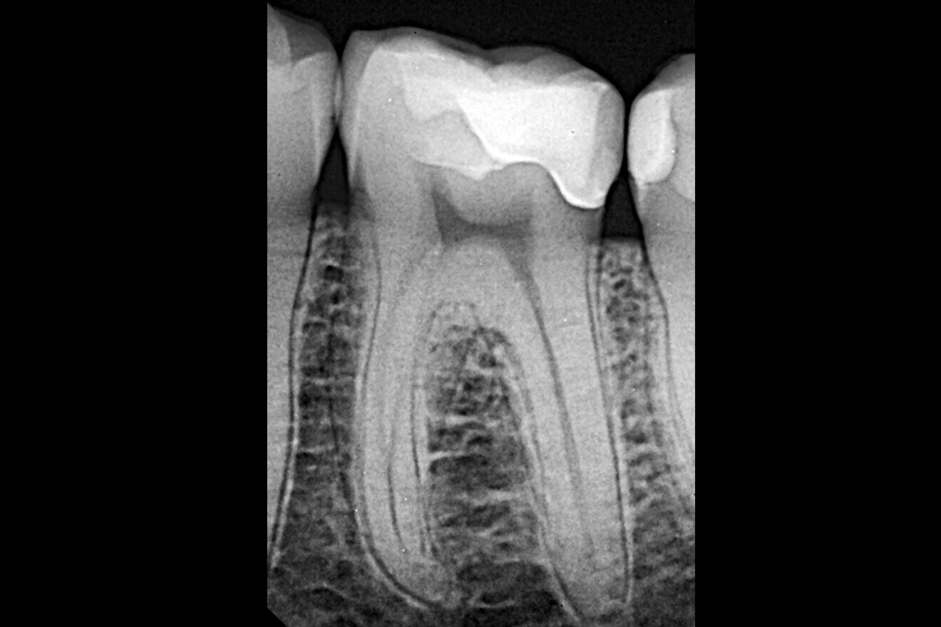 Fig. 27: Final radiograph of the restoration.
