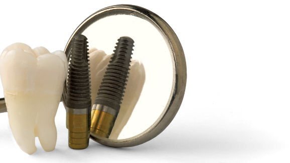 Cochrane-onderzoek: geen verschil in langetermijnsucces tussen implantaten