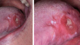 Fig. 5. Carcinoma de lengua. Clínicamente, el tumor puede ser indistinguible, pero existen datos que lo identifican claramente.
