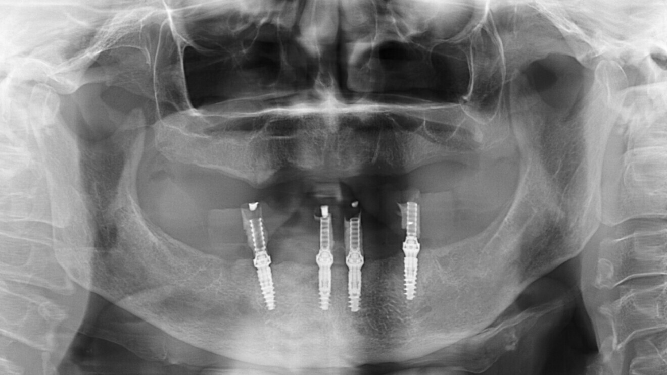 Fig. 14: Radiograph control after placement of the provisional prosthesis.
