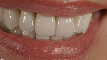 The new NobelProcera system for clinical success: The next level of CAD/CAM dentistry