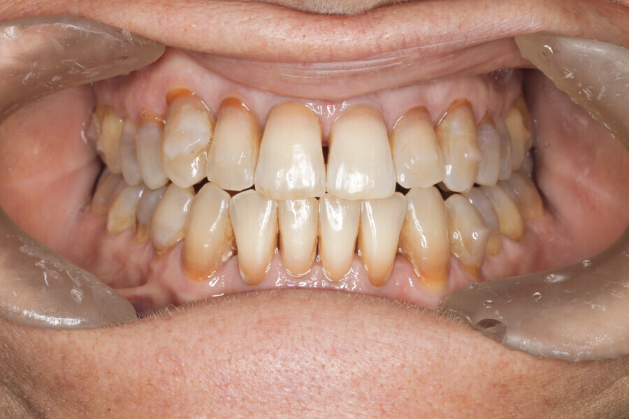 Fig. 47: Situation after 37 Reveal aligners. Case ready for the first refinement. Major change to the patient’s profile.