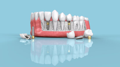 Dentsply Sirona announces comprehensive restage of its implant business