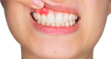 Cellen in gingiva bieden bescherming tegen parodontitis