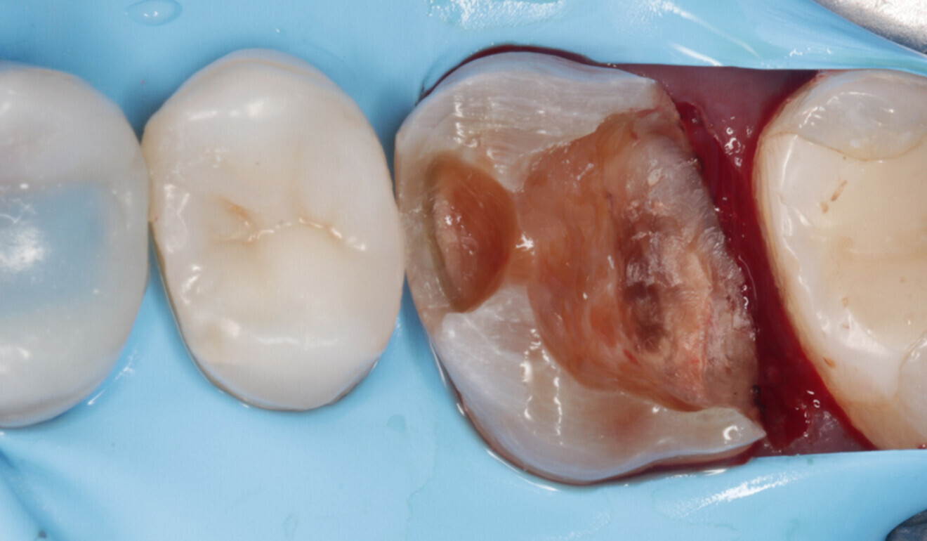 Fig. 5: Gingivectomy performed using an electrical surgical knife. (Image: Kuraray Noritake Dental)