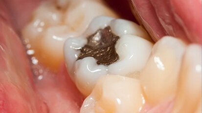 Schweiz unterstützt Einschränkung von Amalgam