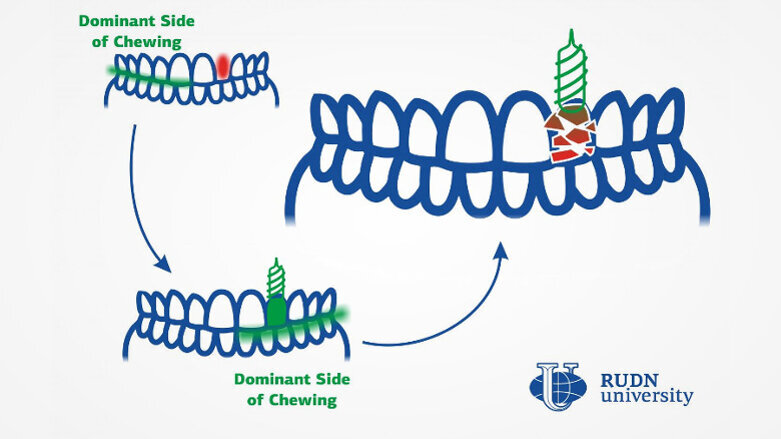 Promena načina žvakanja razlog pogoršanja kod zubnih implantata