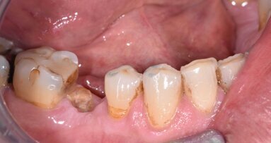 L’estrusione ortodontica: un’opportunità predicibile