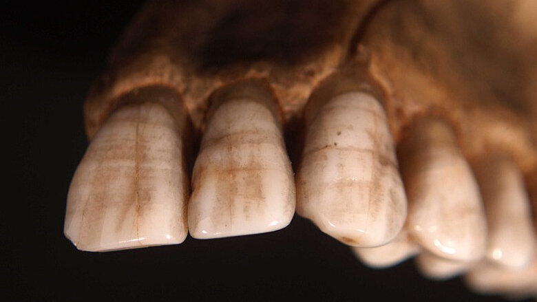 Enamel hypoplasia used to indicate gender equality