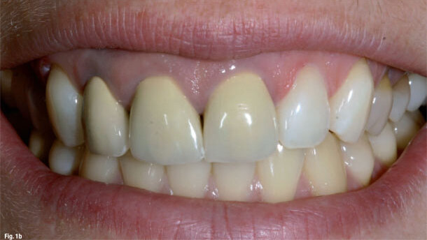 Aesthetics with all-ceramics and tooth whitening