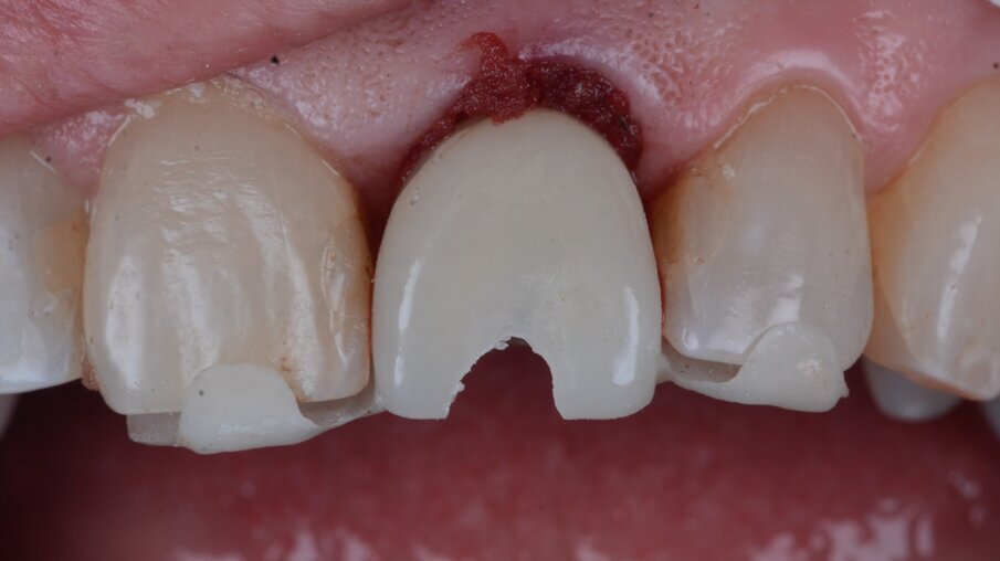 Fig. 25_Dente provvisorio in posizione per la rimozione dell’abutment provvisorio.