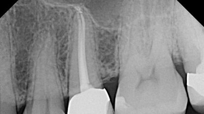 AAE uses Root Canal Awareness Week to dispel myths