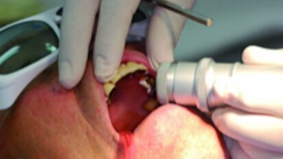 Le laser en dentisterie : passé, présent et futur