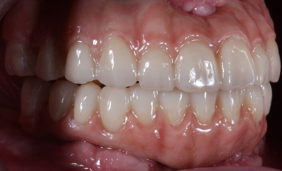 Fig. 19: Final prostheses, right side view. The cervical parts were stained with the shade Cervical 2, the incisal two thirds of the anterior teeth with the shade Grayish Blue and the mamelons with the shade Mamelon Orange 1.