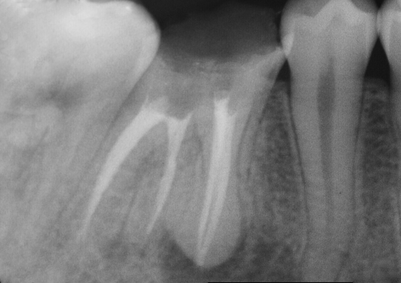 Fig. 3: Post-op results of the endodontic treatment. A proper 3D seal had been achieved. The working length and sealing had been corrected. The extra distal root canal had been found, treated and sealed.