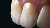 Fig. 13. La morfología y la textura superficial de ambas restauraciones de cerámica sin metal ya no se distinguían de los dientes adyacentes naturales.