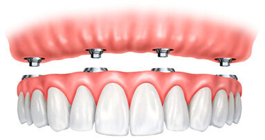 Overdentures su impianti: riabilitazione ancora attuale?