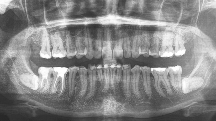 Figg. 9a-9c_Esami radiografici dopo il trattamento, con sovrapposizione sul piano SN. Questo ci mostra come, non potendo proclinare ulteriormente gli incisivi inferiori oltre la sinfisi per sfruttare l’intrusione relativa, l’apertura del morso è stata ottenuta sfruttando al massimo solo movimenti di intrusione assoluta, seppur minimi, e movimenti di intrusione relativa superiore ed estrusione posteriore parziale, considerando la difficoltà di quest’ultima, a causa della tipologia brachifacciale della paziente.