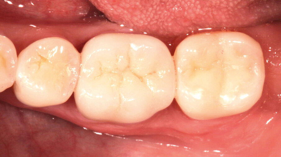 Fig. 11: Situation after crown placement, removal of the excess cement and thorough cleaning. The crown blends in nicely with the surrounding tooth structure.