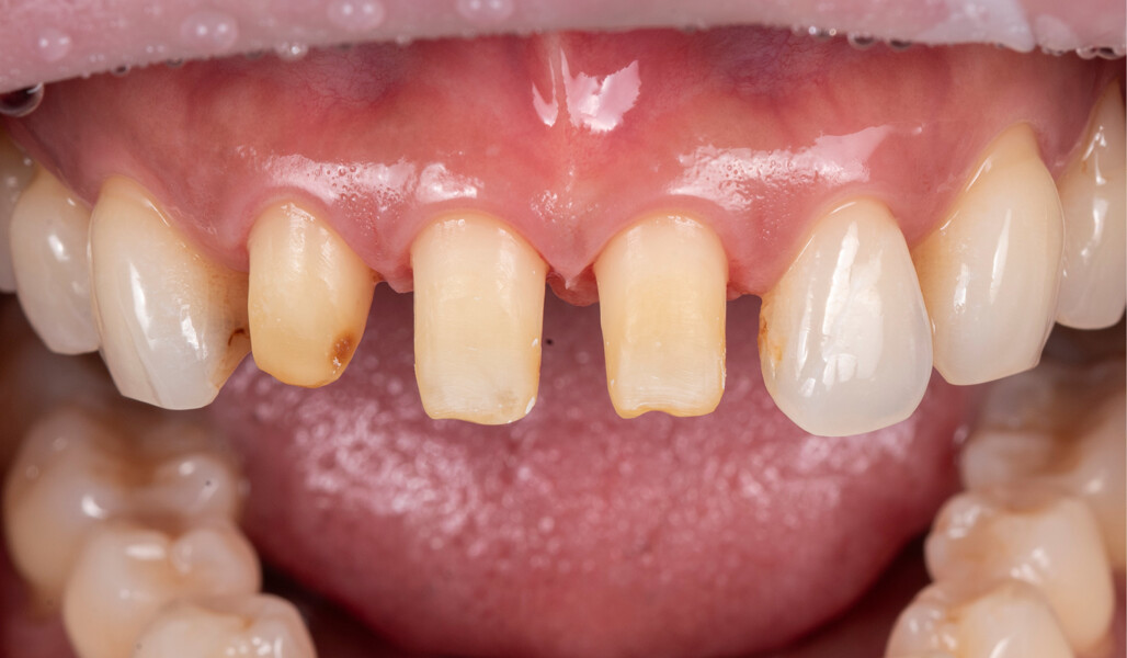 Fig. 2: Situation after removal of the existing crowns and preparation of the tooth structure for the planned ceramic restorations.