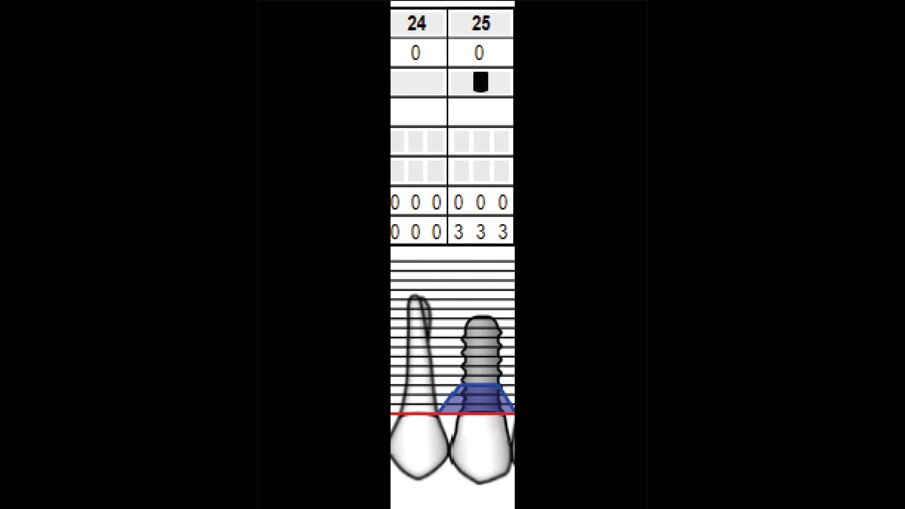 Fig. 8_Parodontogramma di controllo (3 mesi): sondaggi nella norma sui siti 2.4–2.5.