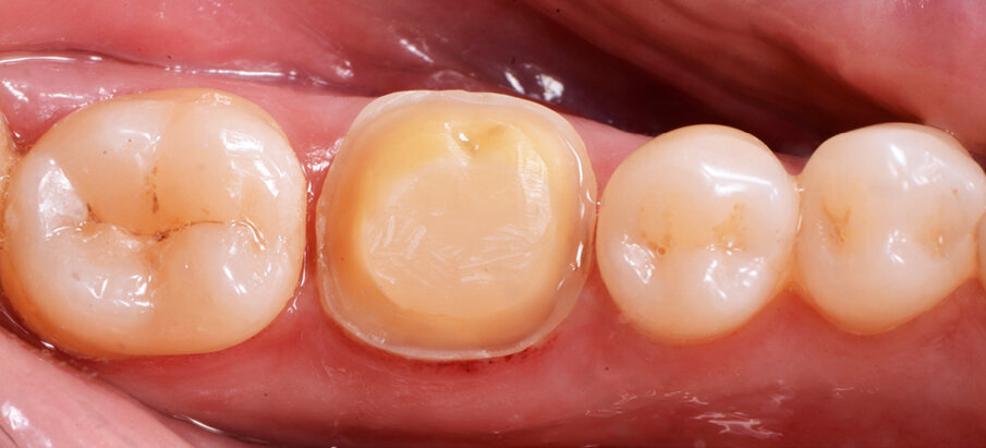 Fig. 2: Situation after composite build-up (Tetric N-Ceram Bulk Fill) and preparation.