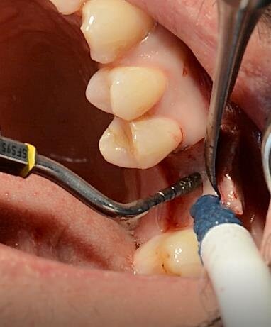 Fig. 13 - Preparazione del tunnel implantare con appositi inserti conici diamantati.