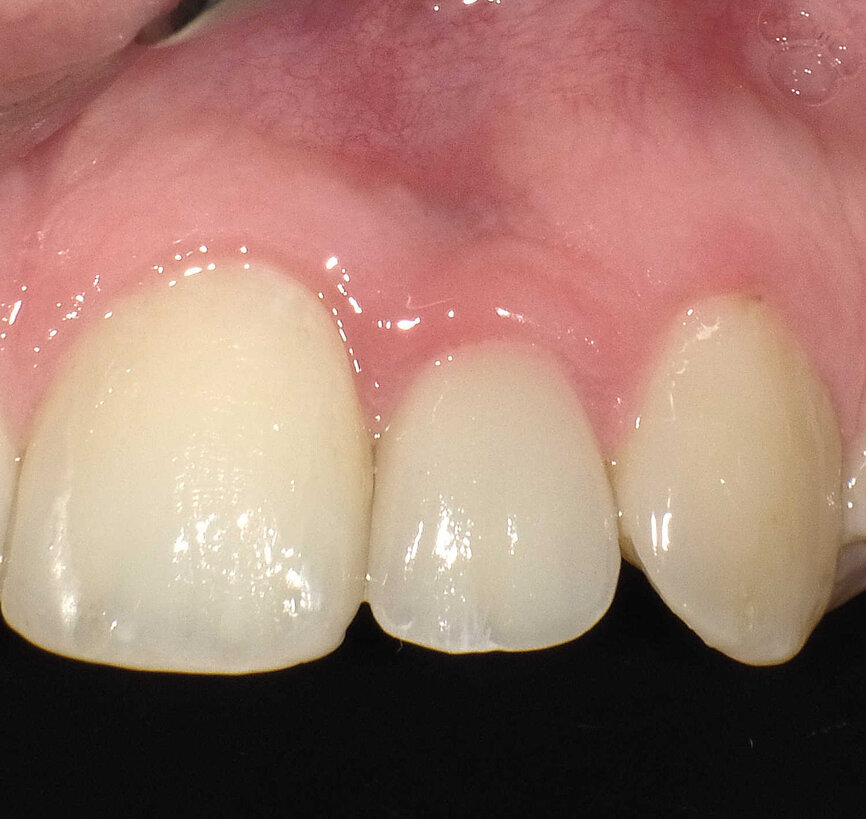 Fig. 9 : Contrôle intraoral de la couronne et du tissu mou périphérique après trois ans. À noter : la stabilité des papilles, soutenues par l’os formé sur l’épaulement incliné.