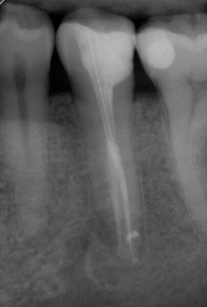Fig. 7b: Radiograph after one year.