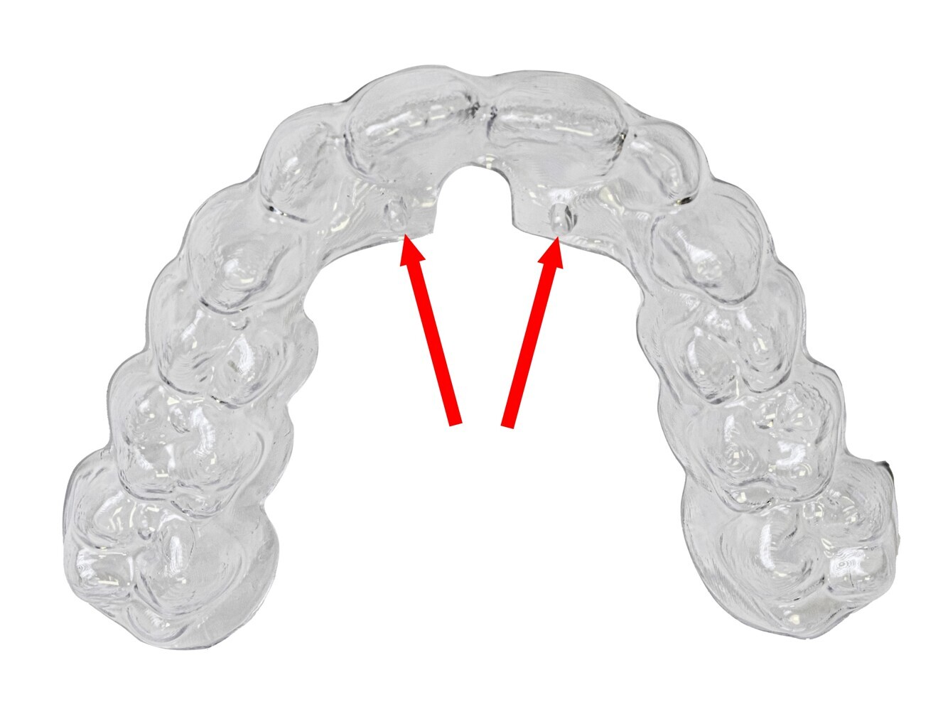 Fig. 5: Nuvola Pro maxillary aligner. Lingual pins indicated by the arrows.