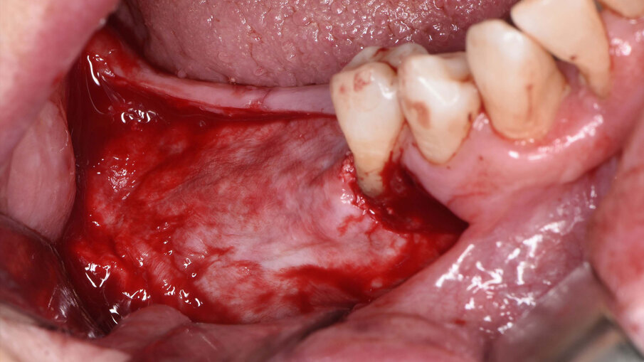 Fig. 6_Visione intra-operatoria della membrana riassorbibile (Geistlich Bio-Gide) posizionata sopra la griglia.