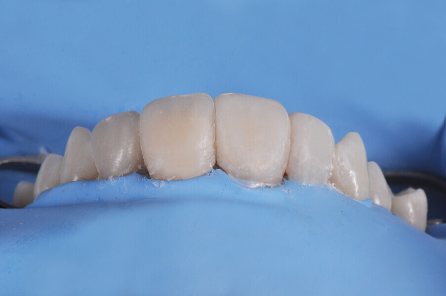 Fig. 19: Situation after flowable injection for all four anterior teeth, light polymerisation through the matrix, matrix removal and excess material removal.