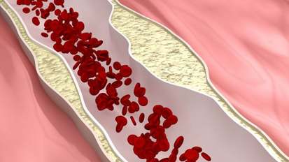La terapia periodontal mejora el corazón en poblaciones de alto riesgo