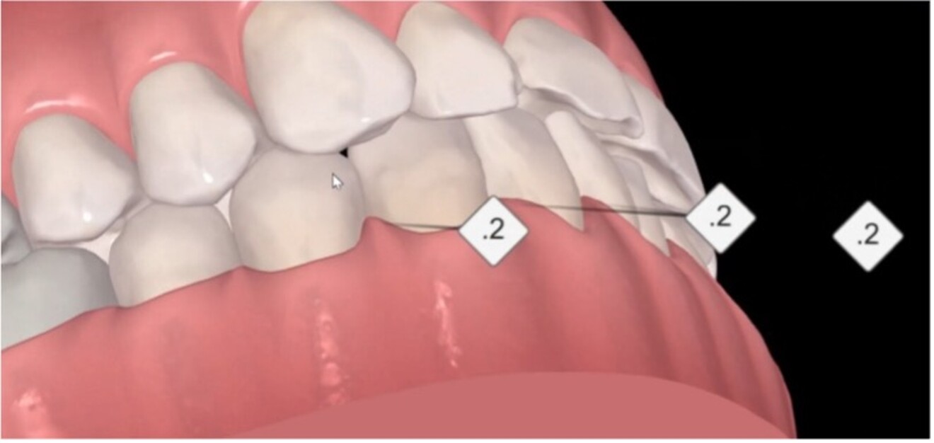 Figs. 2a & b: Side-by-side anterior review of the pre- (a) and post-alignment (b) ClinCheck images.