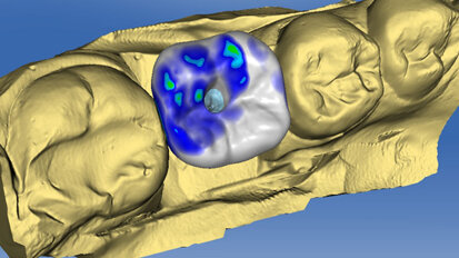 Posizionamento implantare guidato con corona CAD/CAM CEREC
