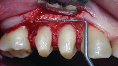 Er:YAG Garnet in laser-assisted crown lengthening