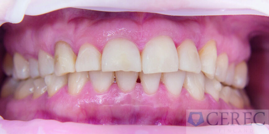 Fig 5: Result after nine months of orthodontic treatment.
