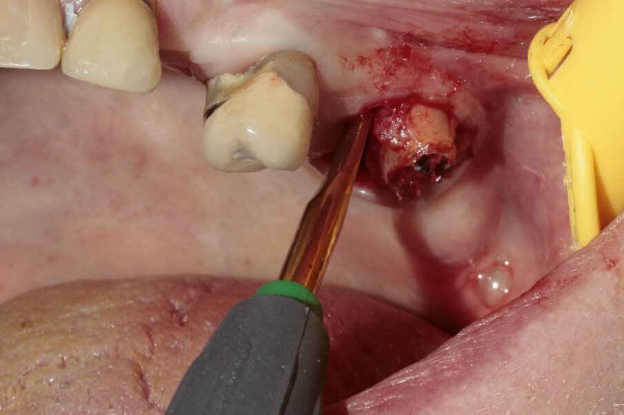 Fig. 8: The mesiobuccal root was luxated.