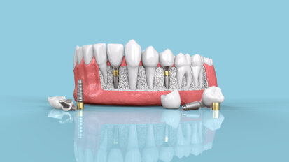 Researchers review dental implant placement using flapless versus flapped technique