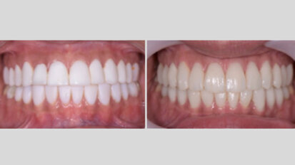 ¿Dientes blancos?