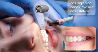 Un sistema que revoluciona la biomecánica en el movimiento dental
