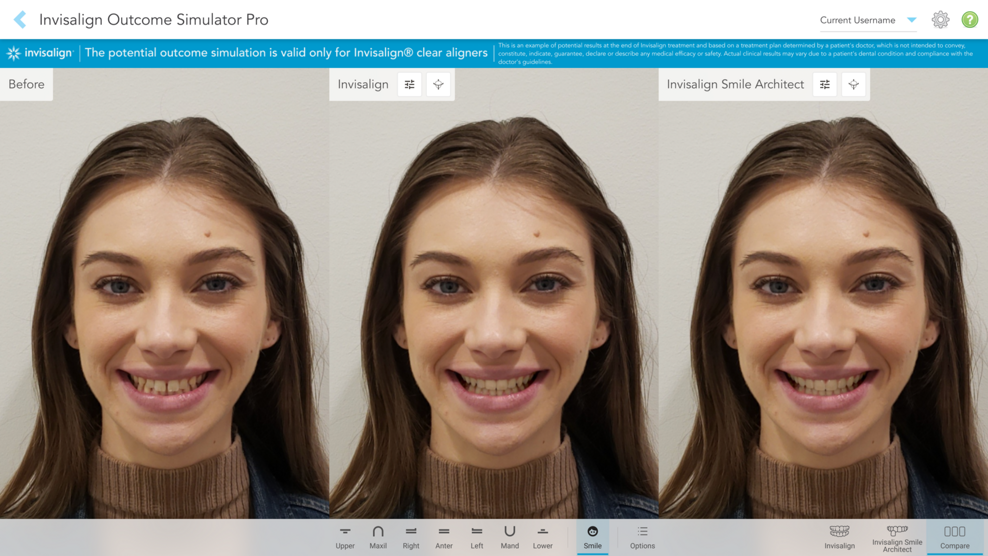 Az Invisalign Outcome Simulator Pro valósághű arcvizualizáció segítségével teszi lehetővé a páciensek számára a kezelés lehetséges eredményeinek megtekintését.